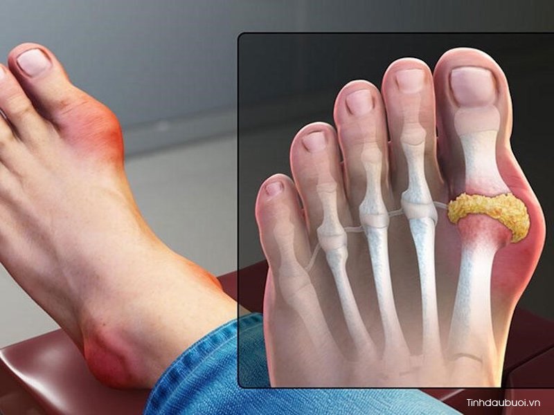 benh gout