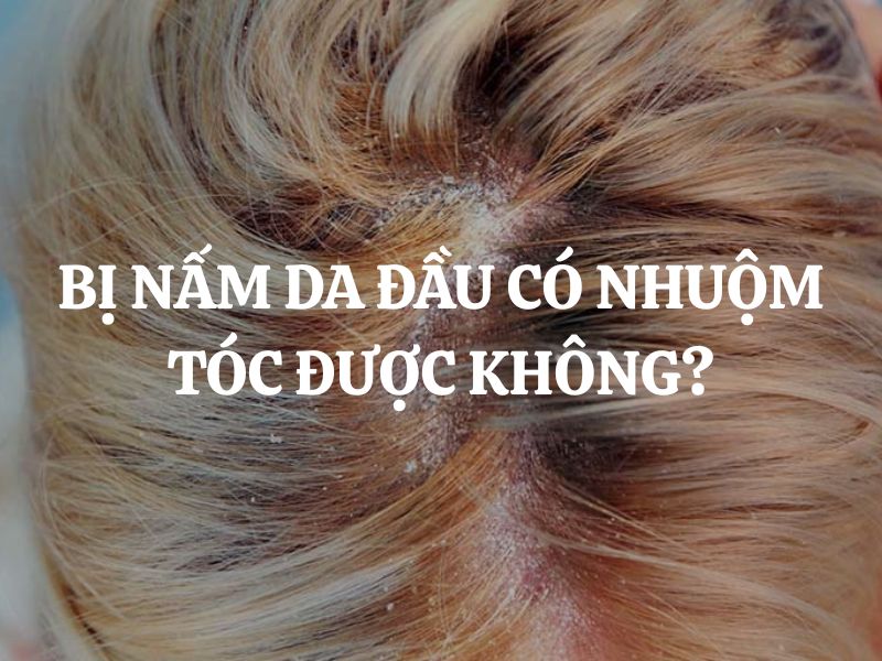 Bị nấm da đầu có nhuộm tóc được không? Giải đáp chi tiết