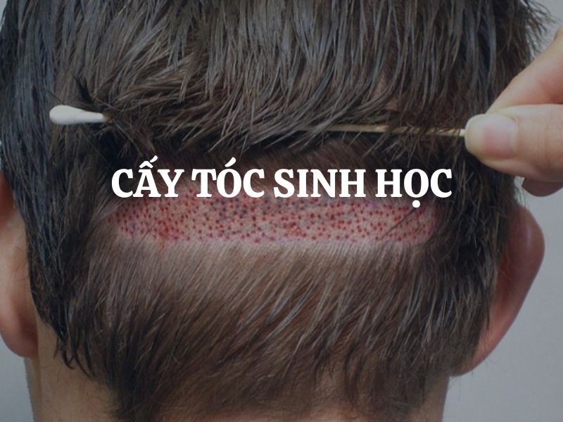Cấy tóc sinh học - Giải pháp thẩm mỹ hiện đại cho mái tóc dày khỏe