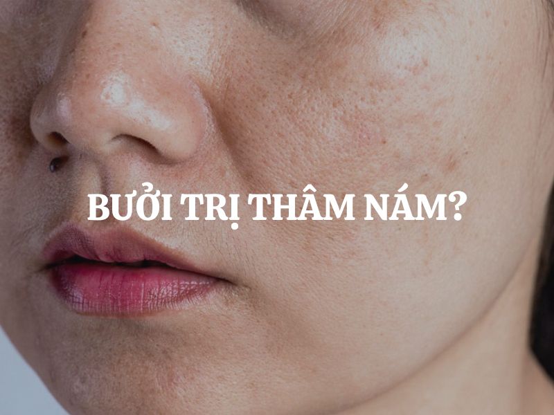 Bưởi trị thâm nám có hiệu quả không? Bí quyết làm đẹp da từ thiên nhiên Bưởi trị thâm nám có hiệu quả không? Bí quyết làm đẹp da từ thiên nhiên