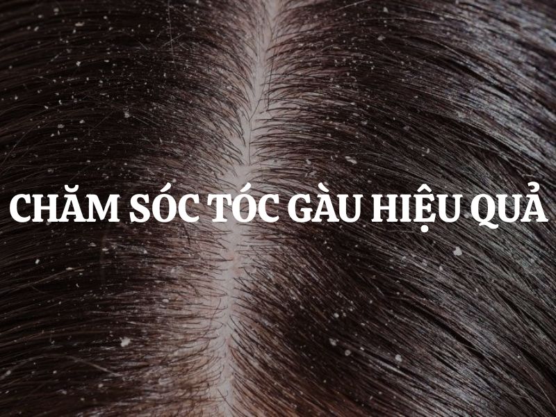 Cách chăm sóc tóc gàu hiệu quả - Bí quyết duy trì mái tóc khỏe, sạch